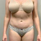 An After Photo of a Tummy Tuck Plastic Surgery by Dr. Craig Jonov in Seattle and Tacoma