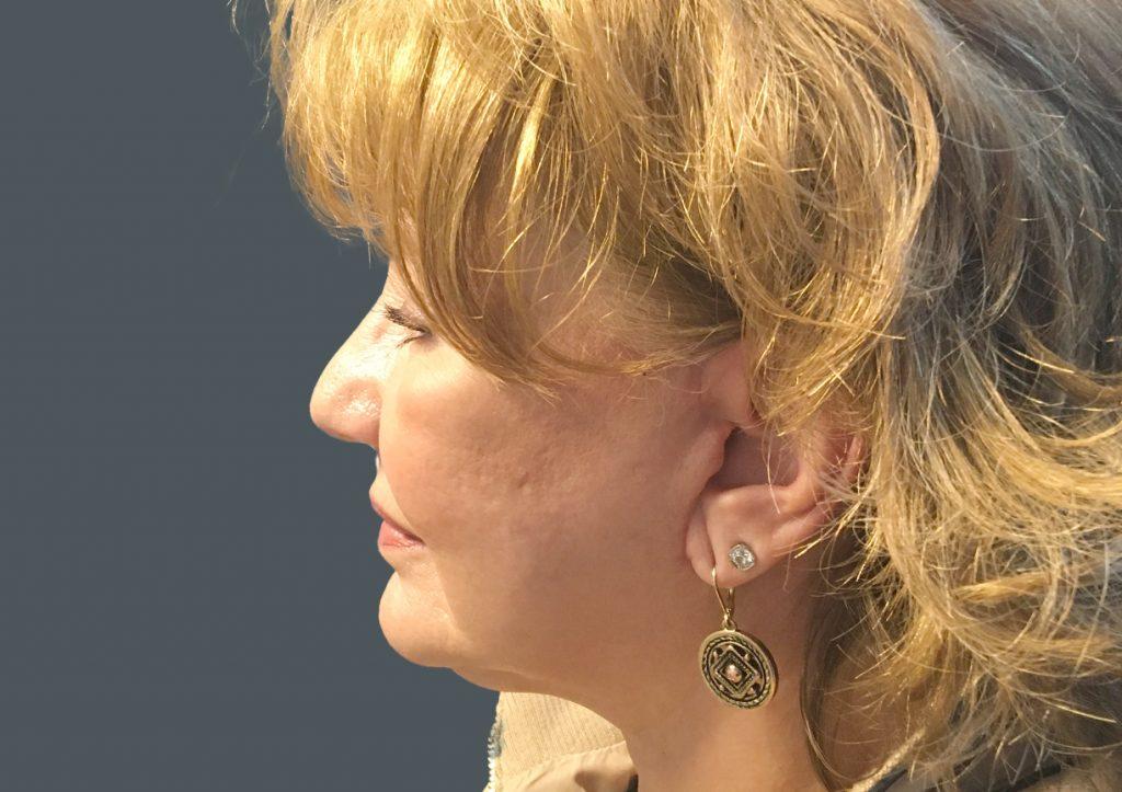 An After Photo of an Extended Facelift Plastic Surgery by Dr. David Santos in Seattle and Tacoma
