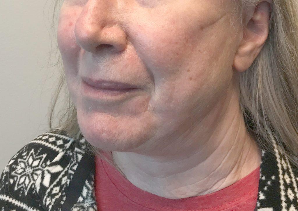An After Photo of Facelift Plastic Surgery by Dr. David Santos in Seattle and Tacoma