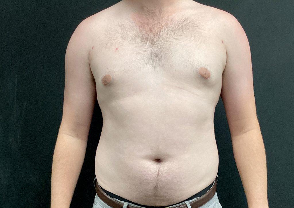 An After Photo of Gynecomastia Plastic Surgery by Dr. Craig Jonov in Seattle and Tacoma