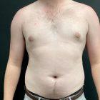 An After Photo of Gynecomastia Plastic Surgery by Dr. Craig Jonov in Seattle and Tacoma