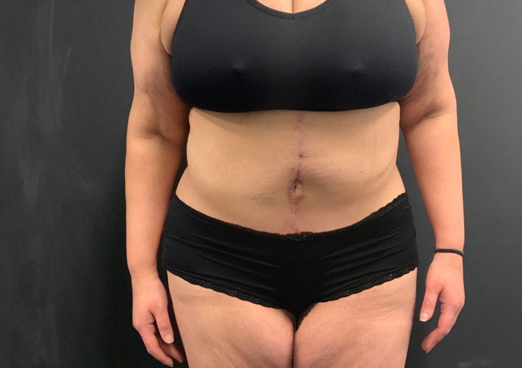 An After Photo of a Fleur-de-lis Tummy Tuck Plastic Surgery by Dr. Craig Jonov in Seattle and Tacoma