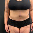 An After Photo of a Fleur-de-lis Tummy Tuck Plastic Surgery by Dr. Craig Jonov in Seattle and Tacoma