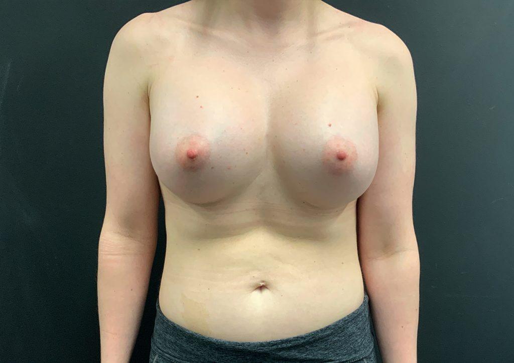 An After Photo of a Breast Augmentation Plastic Surgery in Seattle and Tacoma