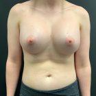 An After Photo of a Breast Augmentation Plastic Surgery in Seattle and Tacoma