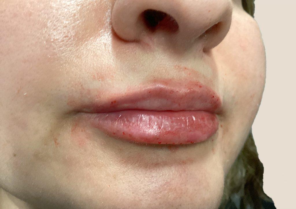 An After Photo of Restylane Kysse Lip Filler in Seattle and Tacoma
