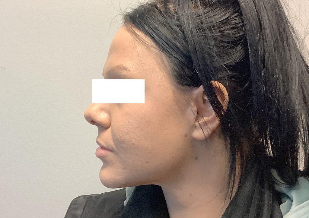 An After Photo of a Facelift Plastic Surgery by Dr. David Santos in Seattle and Tacoma