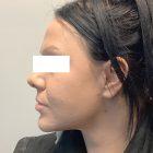An After Photo of a Facelift Plastic Surgery by Dr. David Santos in Seattle and Tacoma