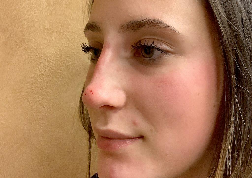 An After Photo of Non-Surgical Rhinoplasty in Seattle and Tacoma