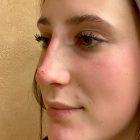 An After Photo of Non-Surgical Rhinoplasty in Seattle and Tacoma