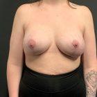 An After Photo of a Breast Augmentation With Lift Plastic Surgery by Dr. Craig Jonov in Seattle and Tacoma