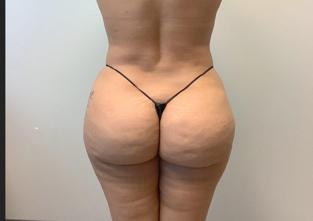 An After Photo of a Brazilian Butt Lift Plastic Surgery in Seattle and Tacoma