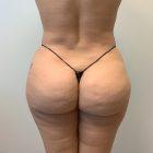 An After Photo of a Brazilian Butt Lift Plastic Surgery in Seattle and Tacoma