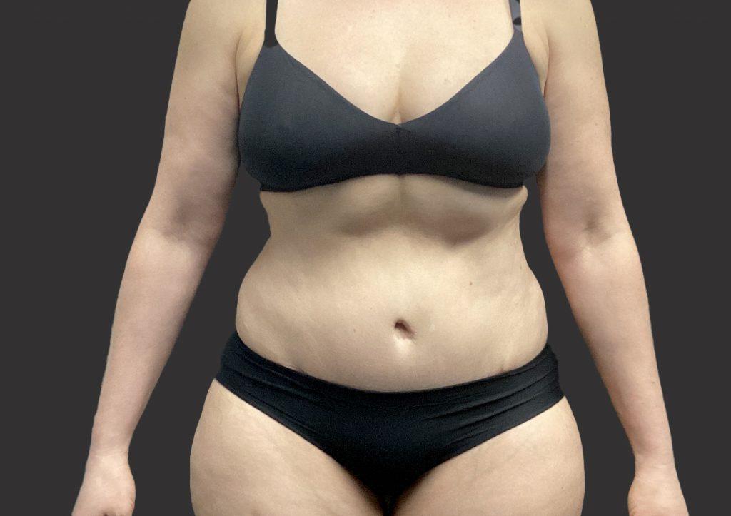 An After Photo of an Extended Tummy Tuck Plastic Surgery by Dr. Craig Jonov in Seattle and Tacoma