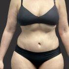 An After Photo of an Extended Tummy Tuck Plastic Surgery by Dr. Craig Jonov in Seattle and Tacoma