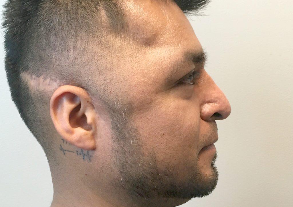 An After Photo of a Male Rhinoplasty Plastic Surgery by Dr. Craig Jonov in Seattle and Tacoma