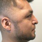 An After Photo of a Male Rhinoplasty Plastic Surgery by Dr. Craig Jonov in Seattle and Tacoma