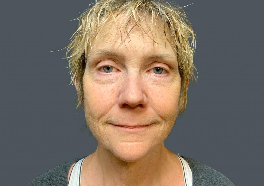 An After Photo of a Brow Lift Plastic Surgery by Dr. Craig Jonov in Seattle and Tacoma