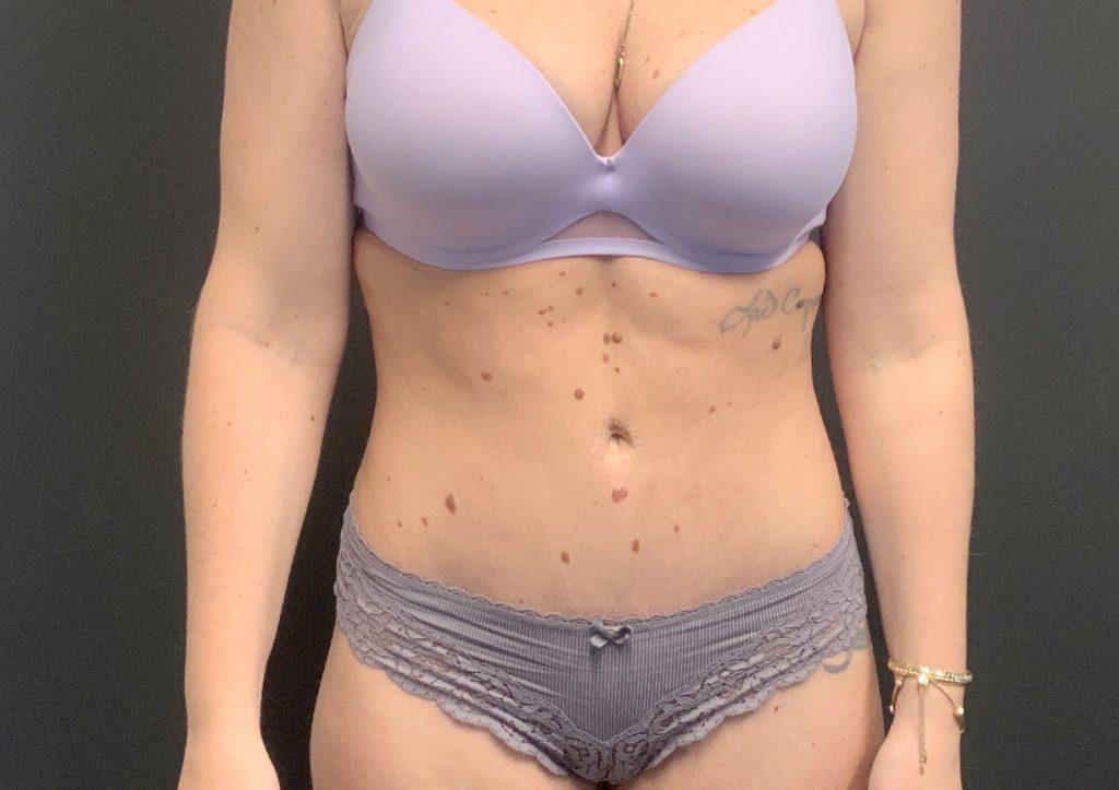 An After Photo of Tummy Tuck Plastic Surgery by Dr. Craig Jonov in Seattle and Tacoma