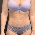 An After Photo of Tummy Tuck Plastic Surgery by Dr. Craig Jonov in Seattle and Tacoma