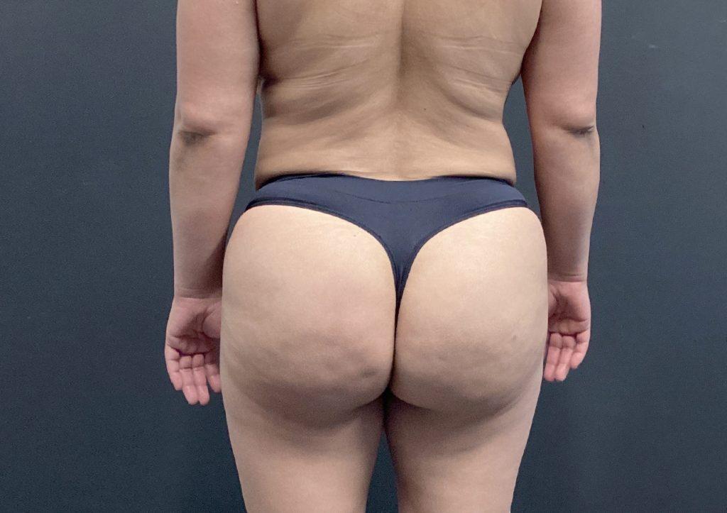 An After Photo of a Brazilian Butt Lift Plastic Surgery by Dr. Craig Jonov in Seattle and Tacoma