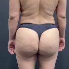 An After Photo of a Brazilian Butt Lift Plastic Surgery by Dr. Craig Jonov in Seattle and Tacoma