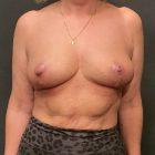 An After Photo of an Auto Augmentation Breast Lift Plastic Surgery by Dr. Craig Jonov in Seattle and Tacoma