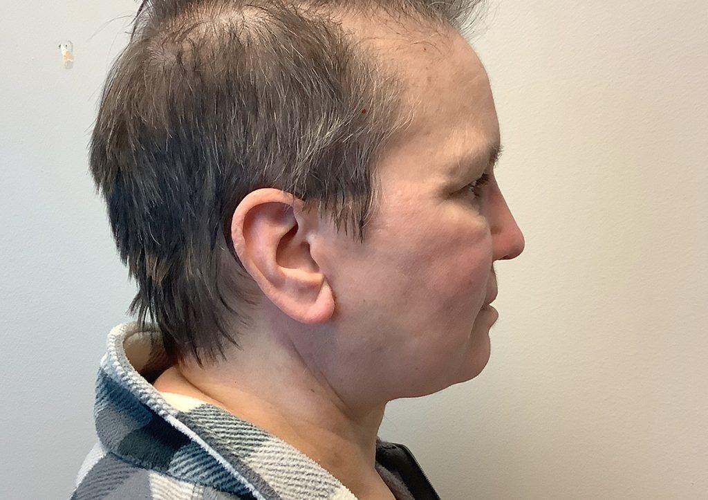 An After Photo of a Facelift with Neck Lift Plastic Surgery by Dr. David Santos in Seattle and Tacoma