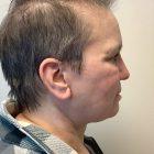 An After Photo of a Facelift with Neck Lift Plastic Surgery by Dr. David Santos in Seattle and Tacoma
