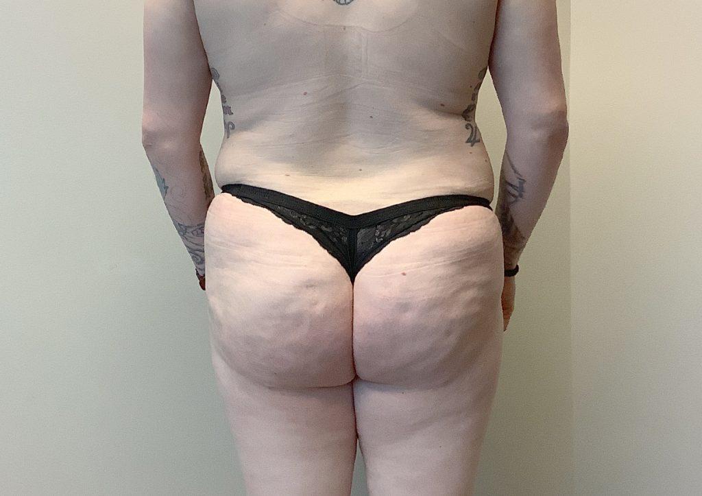 An After Photo of a Brazilian Butt Lift Plastic Surgery by Dr. Craig Jonov in Seattle and Tacoma