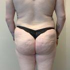 An After Photo of a Brazilian Butt Lift Plastic Surgery by Dr. Craig Jonov in Seattle and Tacoma