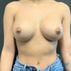 An After Photo of a Breast Augmentation Plastic Surgery by Dr. Craig Jonov in Seattle and Tacoma