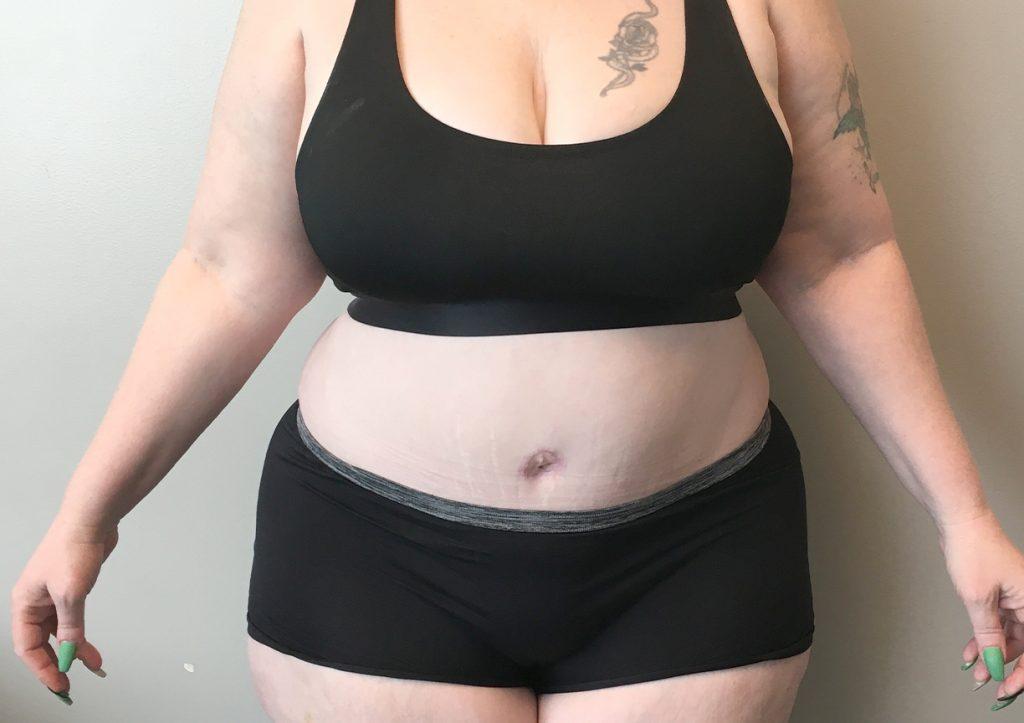 An After Photo of an Extended Tummy Tuck Plastic Surgery by Dr. Craig Jonov in Seattle and Tacoma