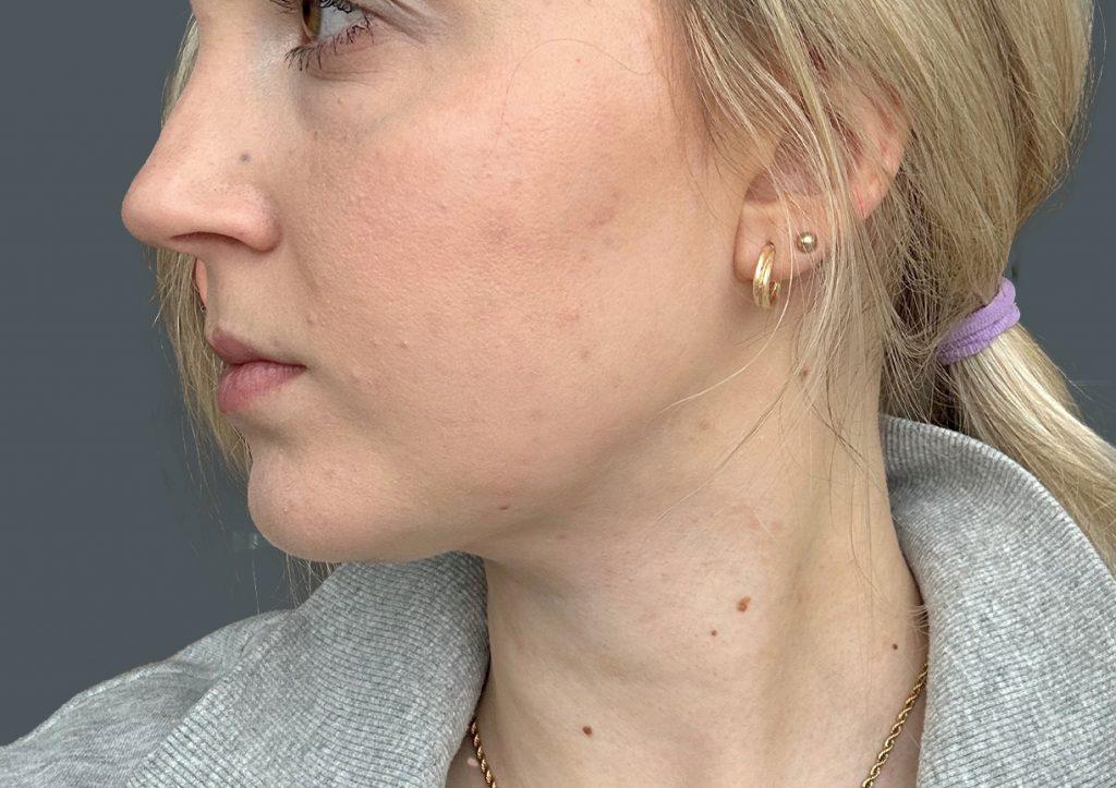 An After Photo of Facial Liposuction Plastic Surgery by Dr. Craig Jonov in Seattle and Tacoma