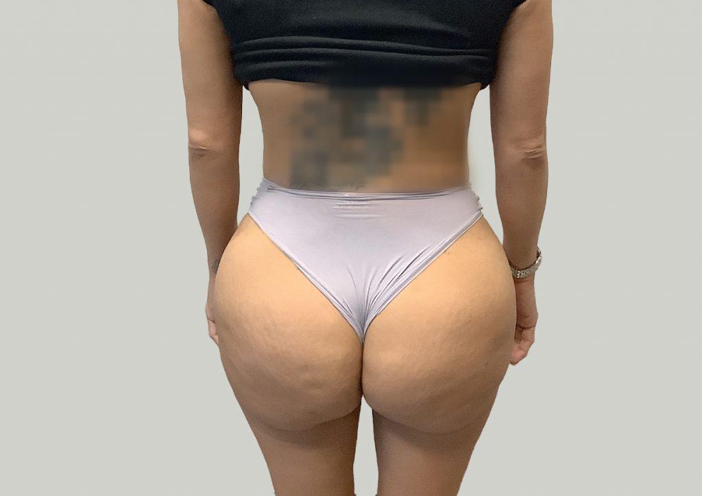 An After Photo of a Brazilian Butt Lift Plastic Surgery by Dr. Craig Jonov in Seattle and Tacoma