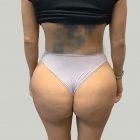 An After Photo of a Brazilian Butt Lift Plastic Surgery by Dr. Craig Jonov in Seattle and Tacoma