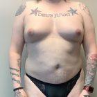 An After Photo of a Fat Transfer to the Breast Plastic Surgery by Dr. Craig Jonov in Seattle and Tacoma