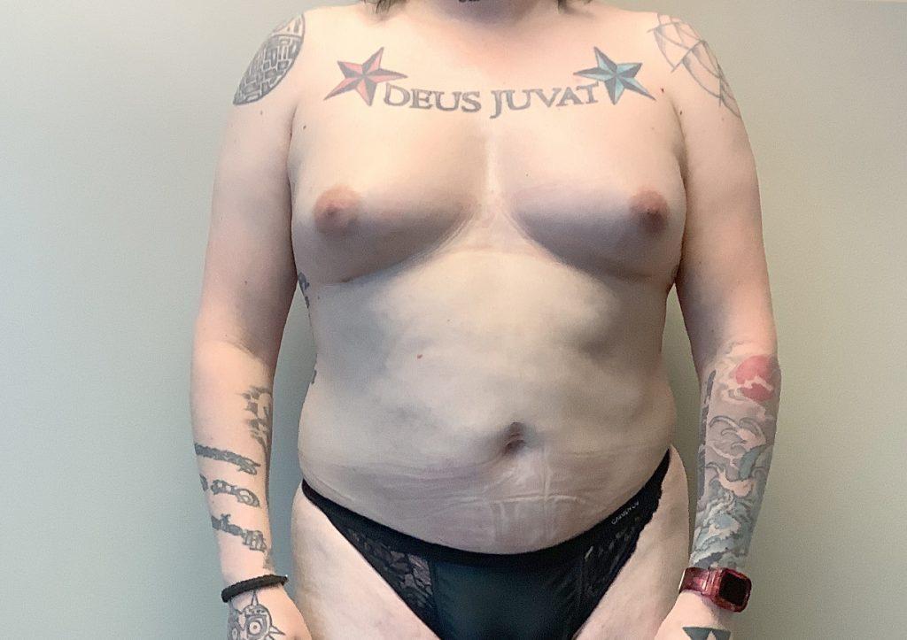 An After Photo of a Fat Transfer to the Breast Plastic Surgery by Dr. Craig Jonov in Seattle and Tacoma