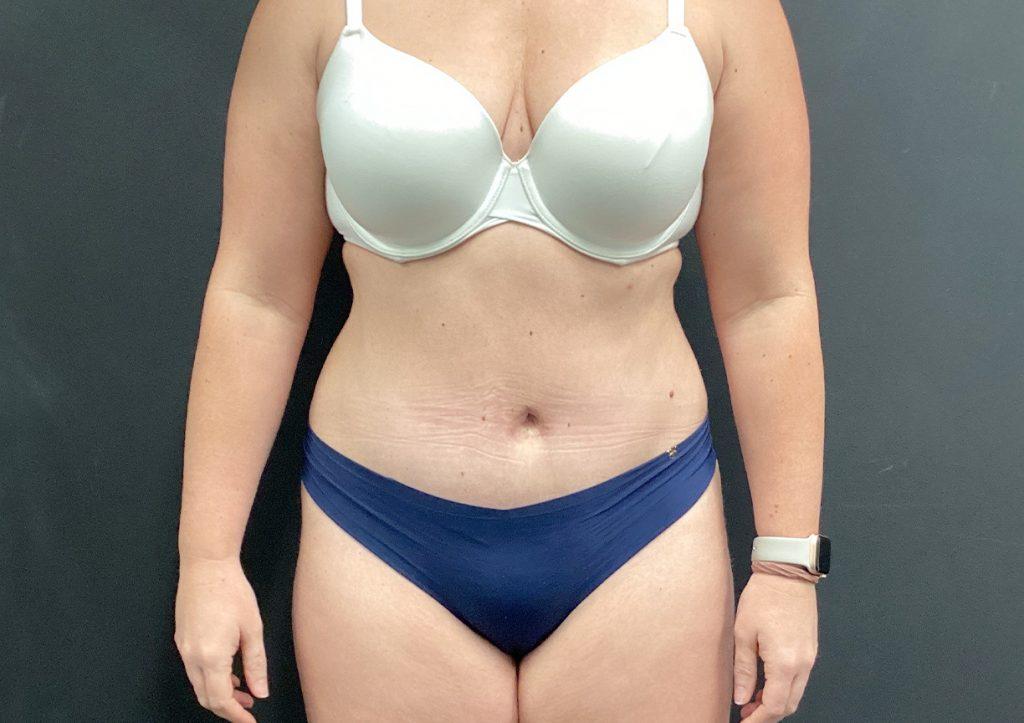 An After Photo of a Tummy Tuck Plastic Surgery by Dr. Craig Jonov in Seattle and Tacoma