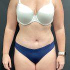 An After Photo of a Tummy Tuck Plastic Surgery by Dr. Craig Jonov in Seattle and Tacoma