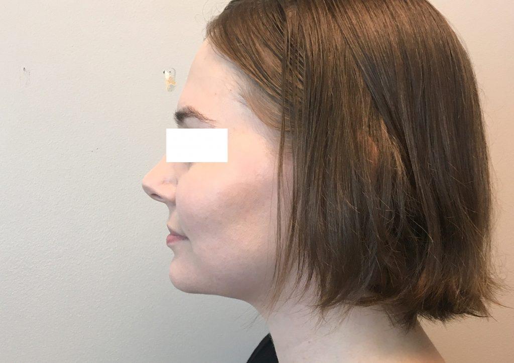 An After Photo of Chin Liposuction Plastic Surgery by Dr. Craig Jonov in Seattle and Tacoma