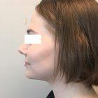 An After Photo of Chin Liposuction Plastic Surgery by Dr. Craig Jonov in Seattle and Tacoma