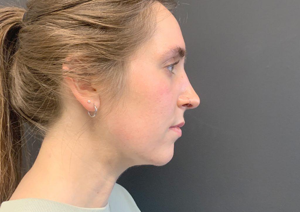 An After Photo of Chin Liposuction Plastic Surgery by Dr. Craig Jonov in Seattle and Tacoma