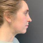 An After Photo of Chin Liposuction Plastic Surgery by Dr. Craig Jonov in Seattle and Tacoma