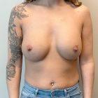 An After Photo of a Breast Augmentation Plastic Surgery by Dr. Craig Jonov in Seattle and Tacoma