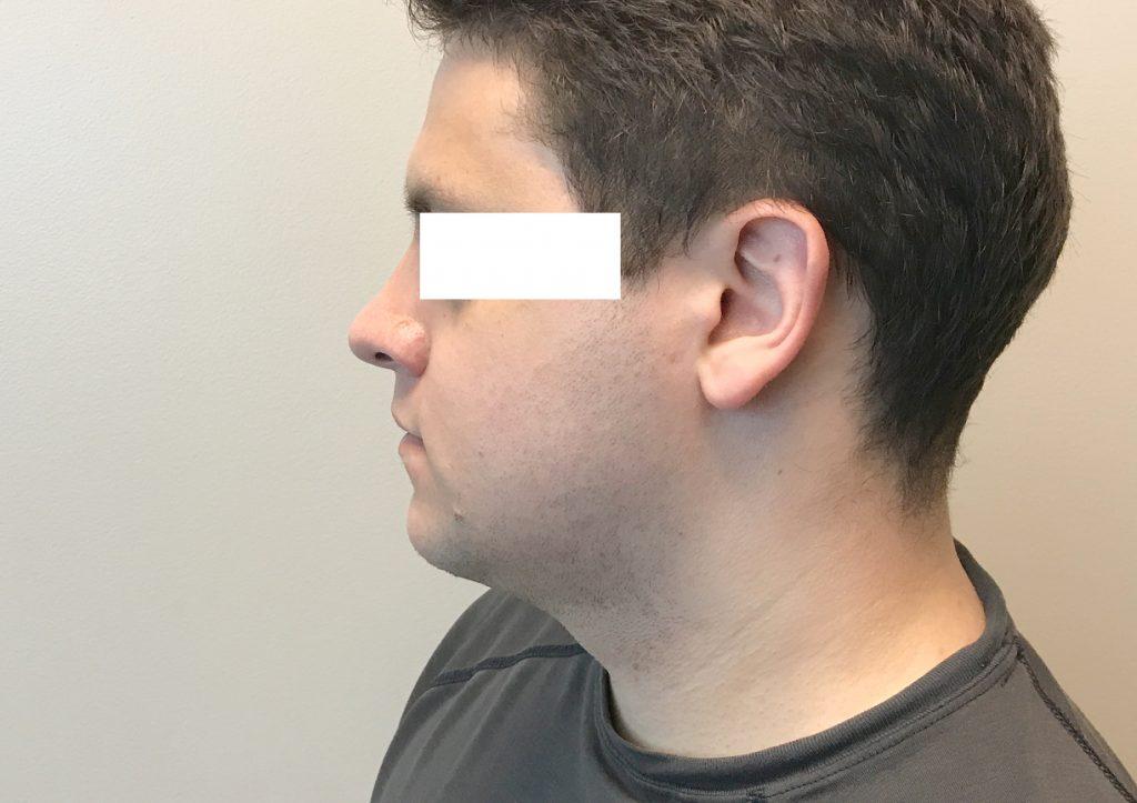 An After Photo of Chin Liposuction Plastic Surgery by Dr. Craig Jonov in Seattle and Tacoma
