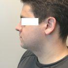 An After Photo of Chin Liposuction Plastic Surgery by Dr. Craig Jonov in Seattle and Tacoma