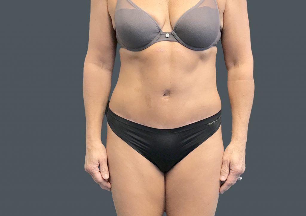 An After Photo of a Tummy Tuck Plastic Surgery by Dr. Craig Jonov in Seattle and Tacoma