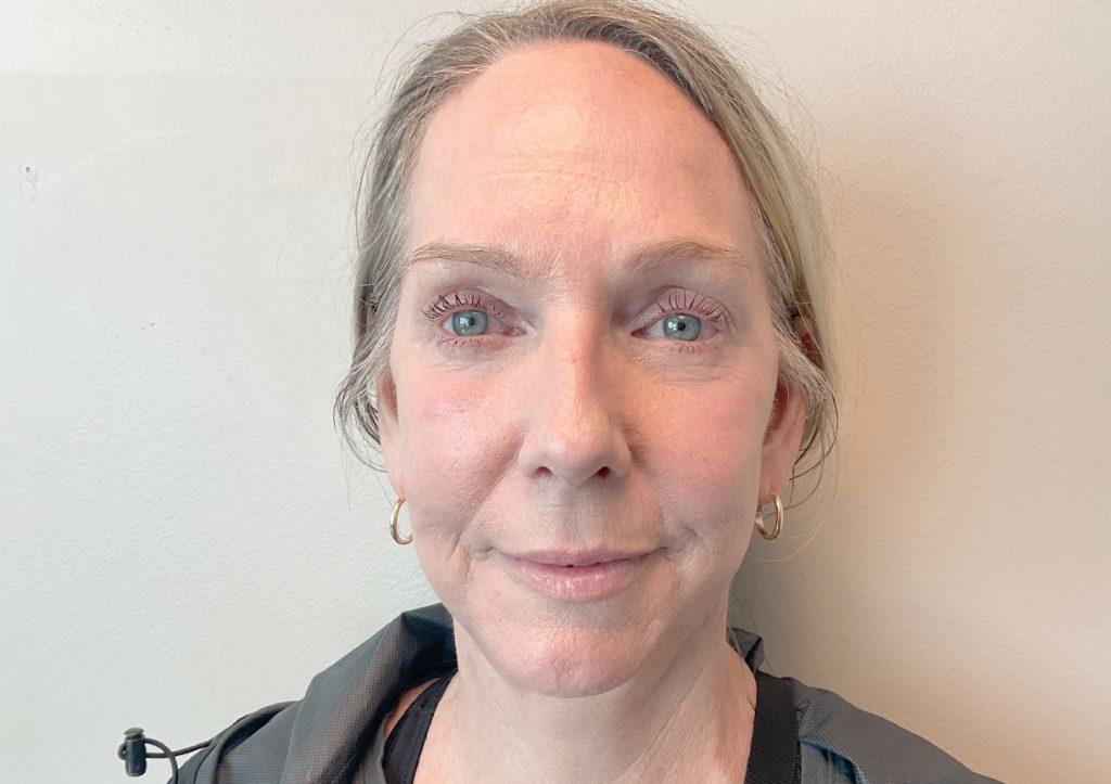 An After Photo of a Facelift with Neck Lift and Brow Lift Plastic Surgery by Dr. David Santos in Seattle and Tacoma