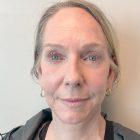 An After Photo of a Facelift with Neck Lift and Brow Lift Plastic Surgery by Dr. David Santos in Seattle and Tacoma